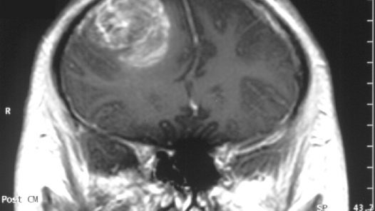 Brain MRI showing Glioblastoma, a type of cancer