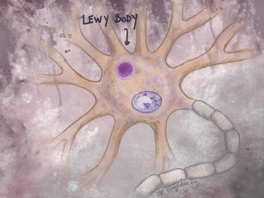 A neuron with Lewy Body. A Lewy Body is abnormal deposit of proteins.