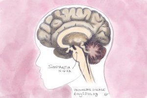 A diagram of the brain showing the substantia nigra, the part of the brain that declines in Parkinson's Disease.