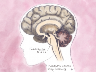 A diagram of the brain showing the substantia nigra, the part of the brain that declines in Parkinson's Disease.