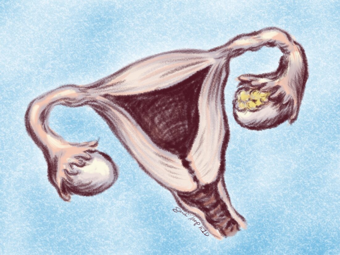 A representation of cancer on an ovary in a sketch with uterus, vagina, fallopian tubes, and ovaries. We talk about ovarian cancer in this episode https://every1dies.org