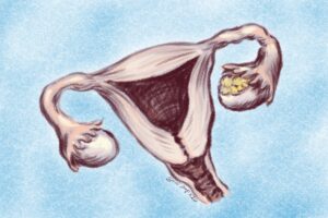 A representation of cancer on an ovary in a sketch with uterus, vagina, fallopian tubes, and ovaries. We talk about ovarian cancer in this episode https://every1dies.org