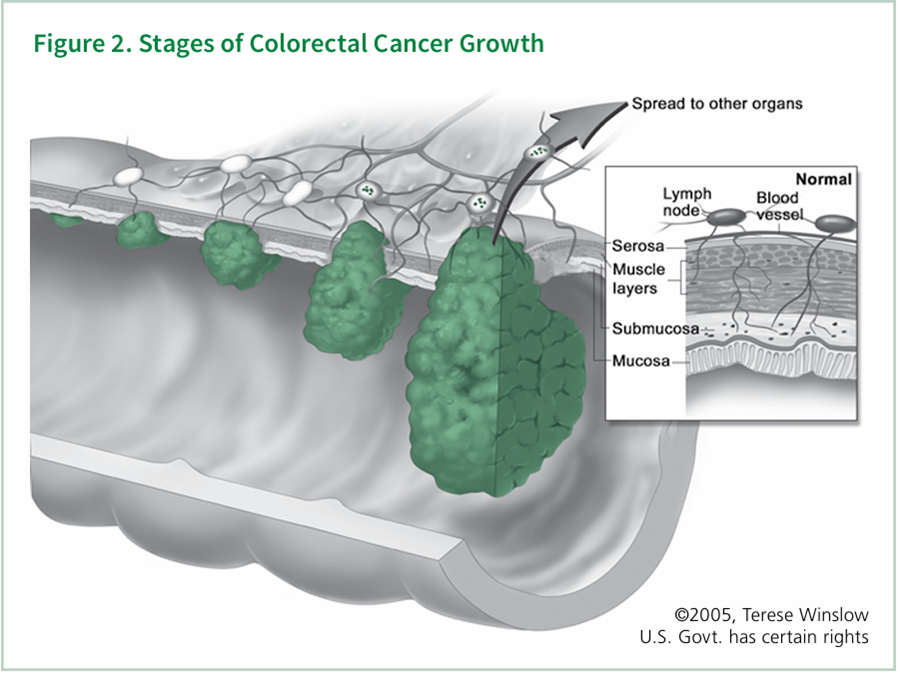 A colon cross-section showing the stages of colorectal cancer growth