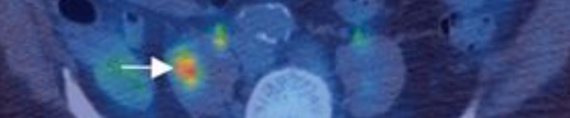 A PET/CT image highlighting a tumor. We talk about what cancer is, how it develops, and factors that contribute to it in this episode. https://every1dies.org