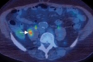 A PET/CT image highlighting a tumor. We talk about what cancer is, how it develops, and factors that contribute to it in this episode. https://every1dies.org