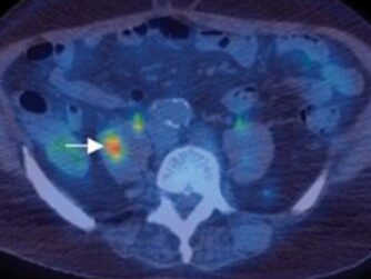 A PET/CT image highlighting a tumor. We talk about what cancer is, how it develops, and factors that contribute to it in this episode. https://every1dies.org