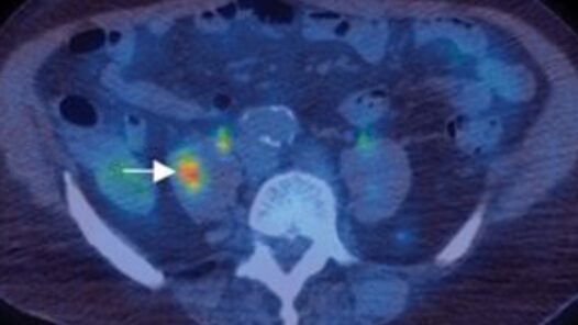 A PET/CT image highlighting a tumor. We talk about what cancer is, how it develops, and factors that contribute to it in this episode. https://every1dies.org