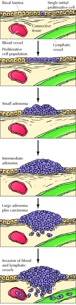 This example of development of a colon carcinoma shows how a single cell can multiply into a lump called an adenoma. It becomes a cancerous tumor and starts to invade the tissue below. Eventually it reaches the blood vessels and lymph channels, which allow the cancer cells to spread to other parts of the body.
