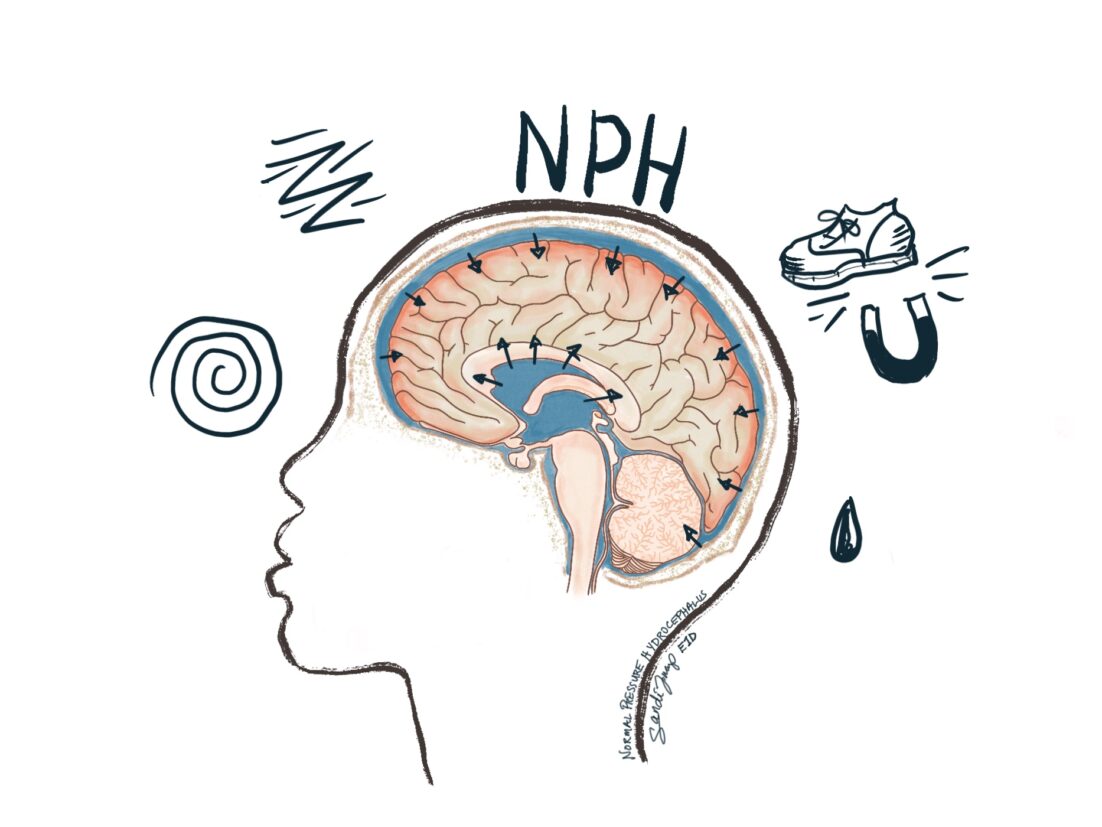 A brain with increased CSF, putting pressure on the brain. Normal pressure hydrocephalus causes confusion, unsteadiness with a wobbly "magnetic gait," and incontinence. If left untreated it can cause dementia.