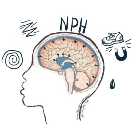A brain with increased CSF, putting pressure on the brain. Normal pressure hydrocephalus causes confusion, unsteadiness with a wobbly "magnetic gait," and incontinence. If left untreated it can cause dementia.