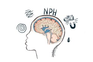 A brain with increased CSF, putting pressure on the brain. Normal pressure hydrocephalus causes confusion, unsteadiness with a wobbly "magnetic gait," and incontinence. If left untreated it can cause dementia.