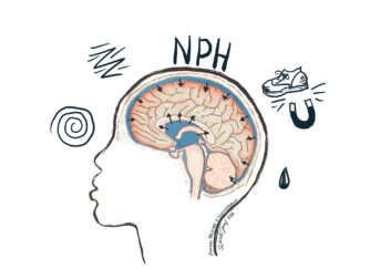 A brain with increased CSF, putting pressure on the brain. Normal pressure hydrocephalus causes confusion, unsteadiness with a wobbly "magnetic gait," and incontinence. If left untreated it can cause dementia.