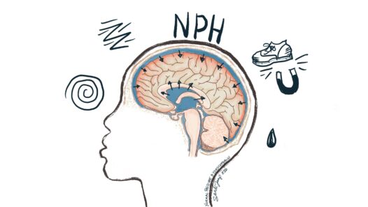 A brain with increased CSF, putting pressure on the brain. Normal pressure hydrocephalus causes confusion, unsteadiness with a wobbly "magnetic gait," and incontinence. If left untreated it can cause dementia.