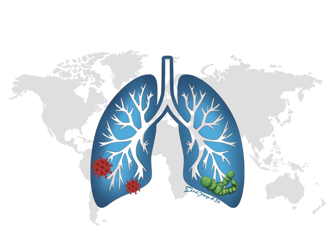 A lung against a backdrop of the globe. The base of the lung has representative microbes that cause pneumonia, such as viruses and pneumococcus. Learn all about pneumonia in this episode.
