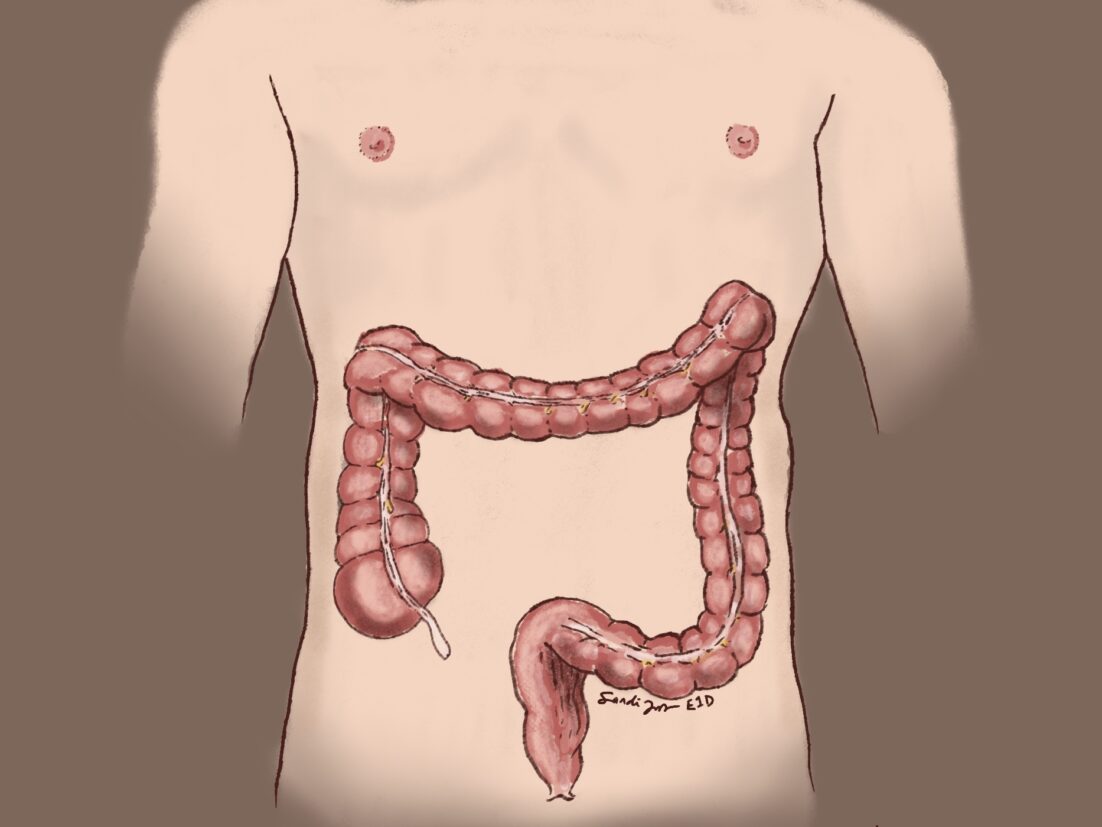 A simplified anatomic image highlighting the colon and rectum on a male outline