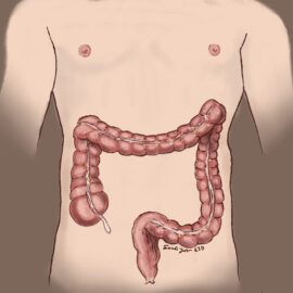 A simplified anatomic image highlighting the colon and rectum on a male outline