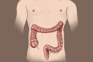 A simplified anatomic image highlighting the colon and rectum on a male outline