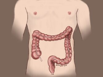 A simplified anatomic image highlighting the colon and rectum on a male outline