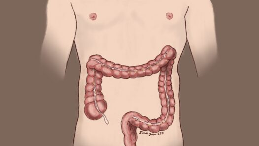 A simplified anatomic image highlighting the colon and rectum on a male outline