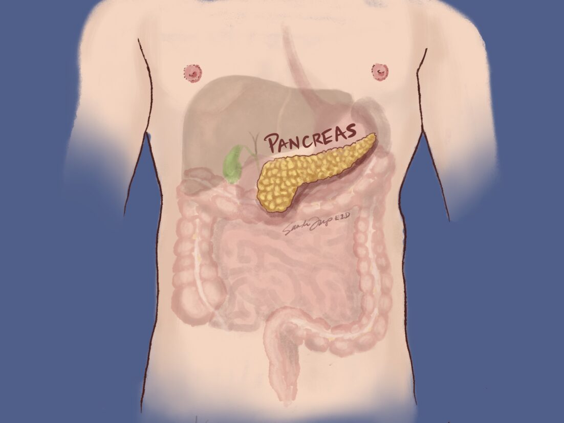 A medical image highlighting the position of the pancreas, surrounded by the liver, gall bladder stomach, spleen, and intestines. We talk about these internal organs being affected by and often removed in treatment of pancreatic cancer.