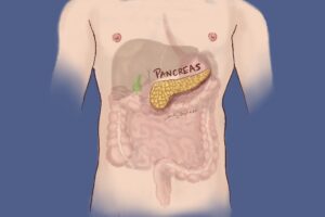 A medical image highlighting the position of the pancreas, surrounded by the liver, gall bladder stomach, spleen, and intestines. We talk about these internal organs being affected by and often removed in treatment of pancreatic cancer.