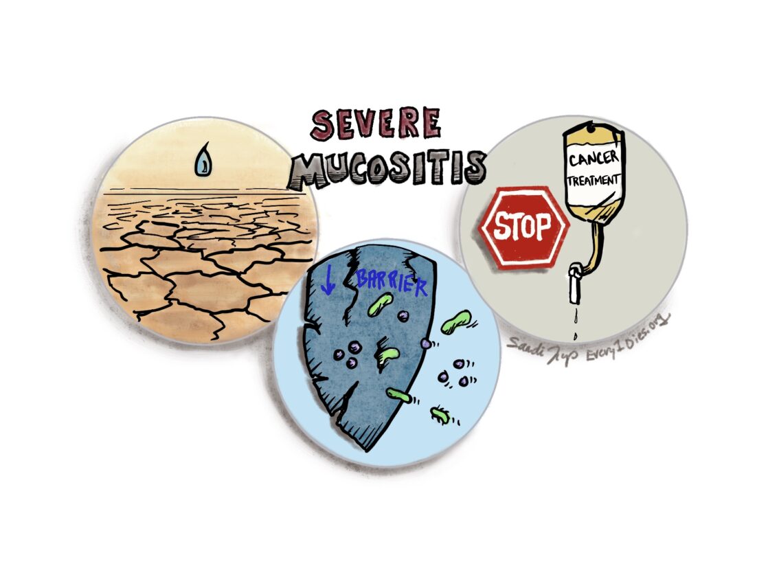 Some of the impacts of severe oral mucositis are dehydration, decreased barrier to infection leading to sepsis, and possible pause in cancer treatment, as shown with three different icons.