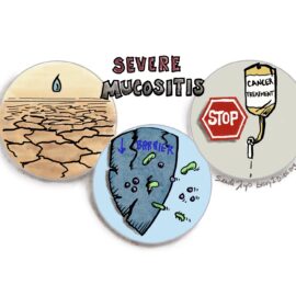 Some of the impacts of severe oral mucositis are dehydration, decreased barrier to infection leading to sepsis, and possible pause in cancer treatment, as shown with three different icons.