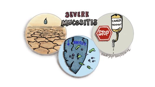 Some of the impacts of severe oral mucositis are dehydration, decreased barrier to infection leading to sepsis, and possible pause in cancer treatment, as shown with three different icons.
