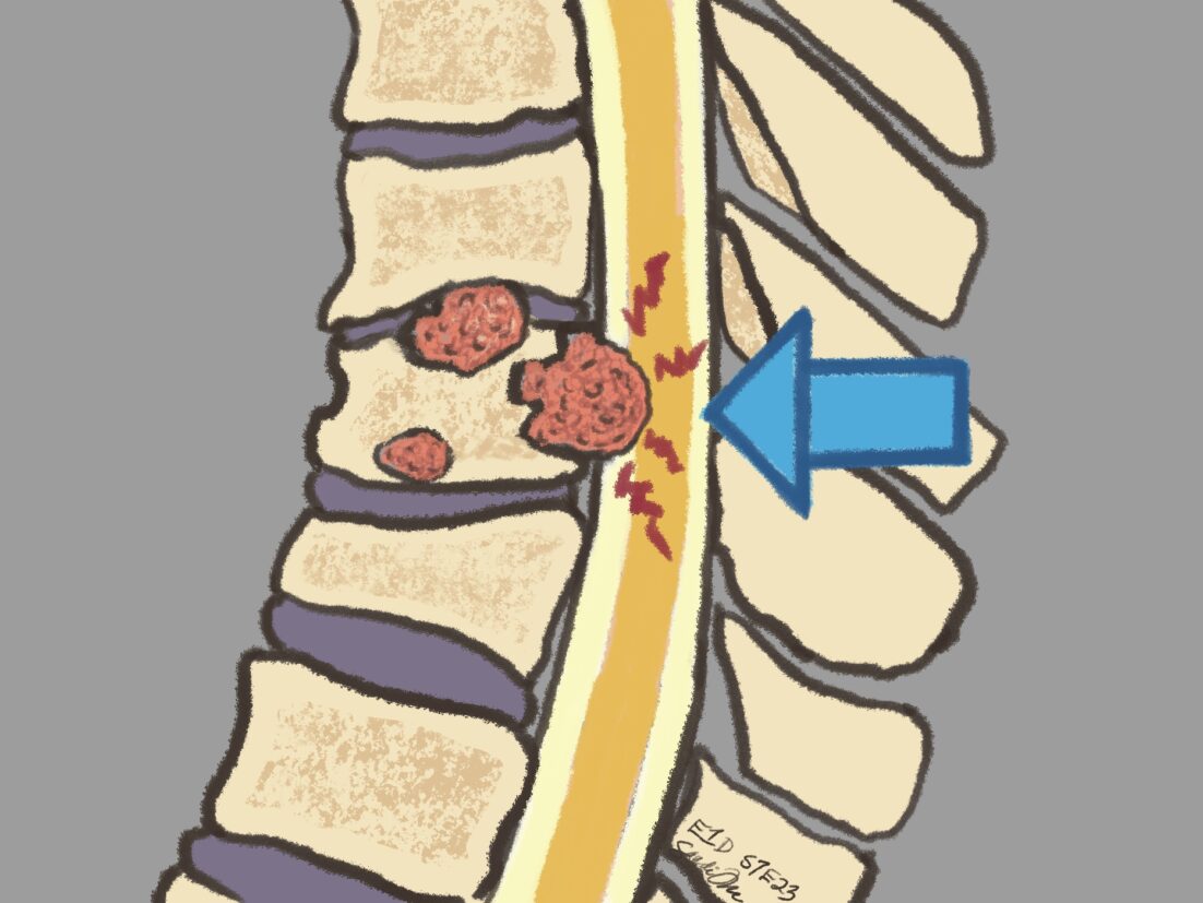 A cross-section of the spinal column showing cancer in the vertebrae pushing on the spinal cord. Learn about this cancer emergency in S7E23.