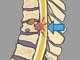 A cross-section of the spinal column showing cancer in the vertebrae pushing on the spinal cord. Learn about this cancer emergency in S7E23.