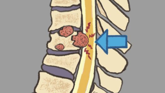 A cross-section of the spinal column showing cancer in the vertebrae pushing on the spinal cord. Learn about this cancer emergency in S7E23.